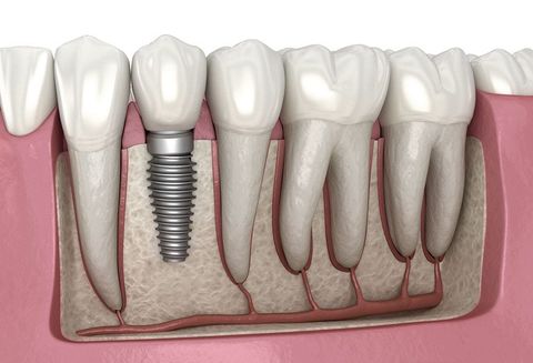 Maxillofacial Implant Manufacturing: Process, Materials & Technology