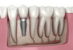 Dental Implants: Procedure, Options, Materials & Technology