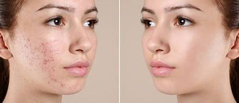 A Guide to Women’s Scar Treatment and Skin Care