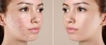 A Guide to Women’s Scar Treatment and Skin Care